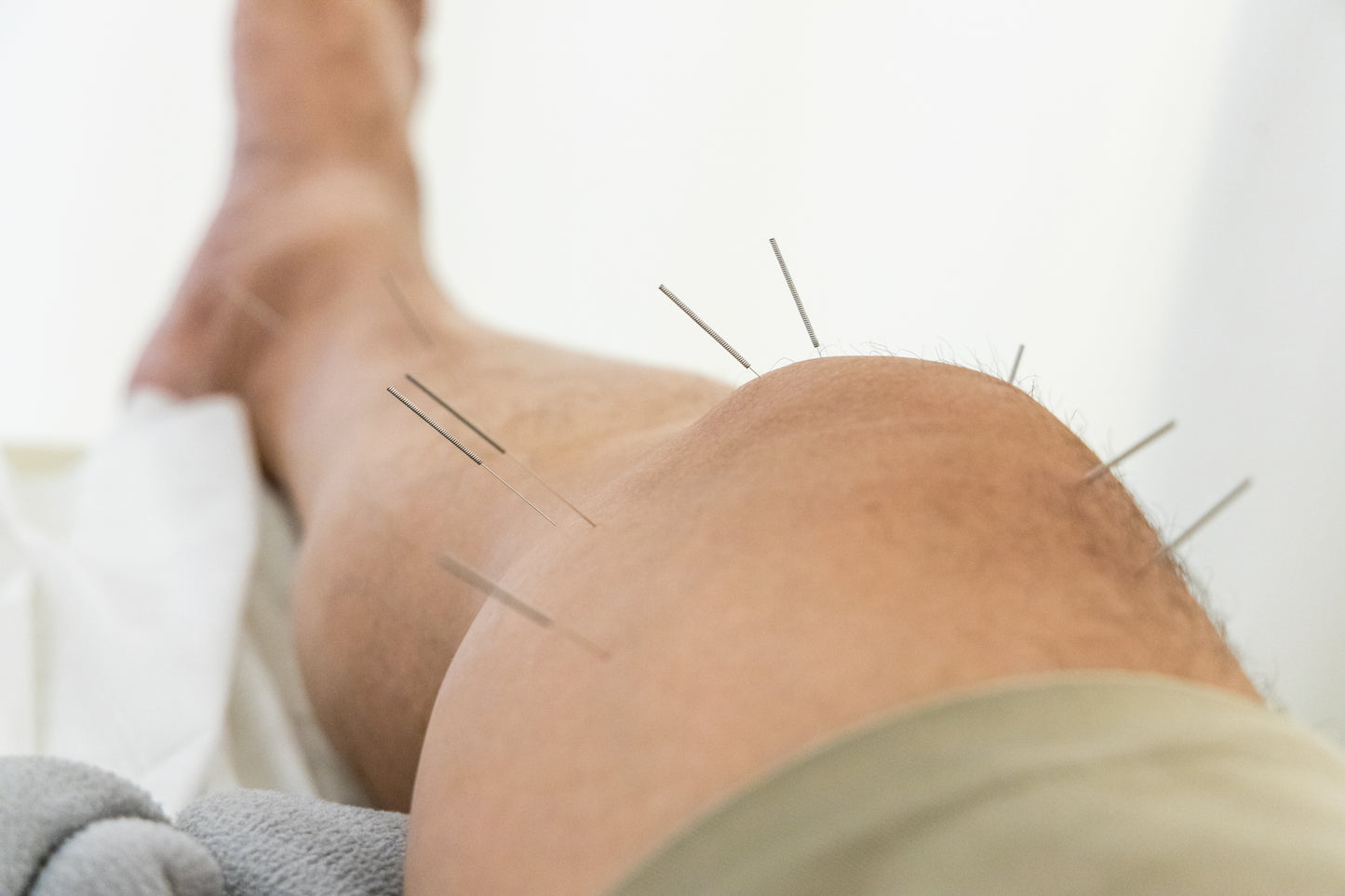6 Session Acupuncture Package