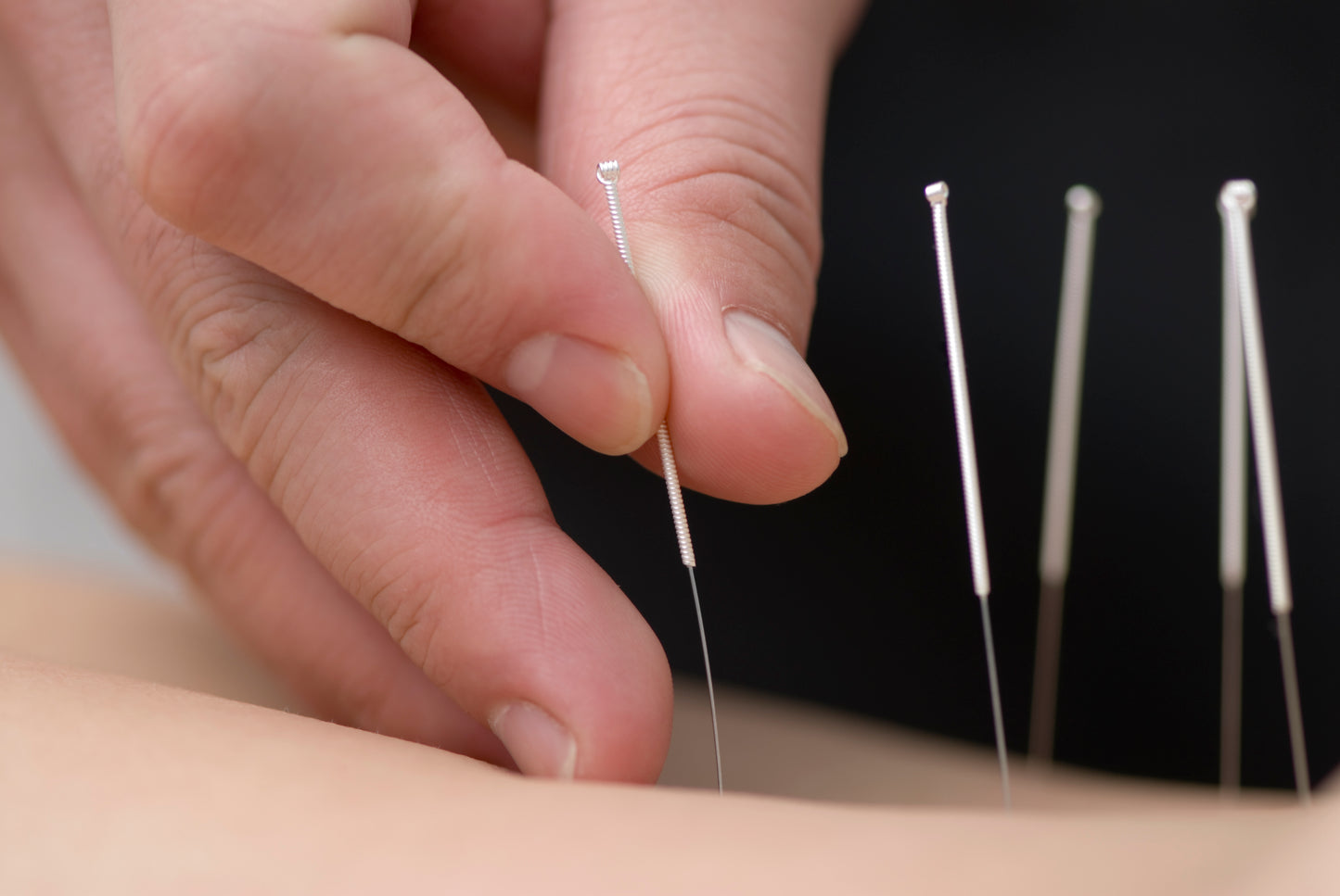 20 Session Acupuncture Package